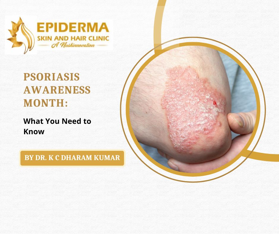 Best Psoriasis Treatment in Bangalore | Dr. K C Dharam Kumar