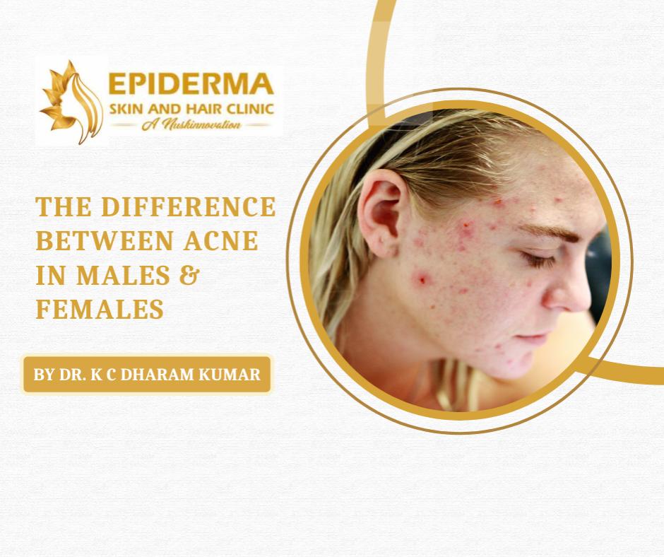 acne treatment in Jayanagar