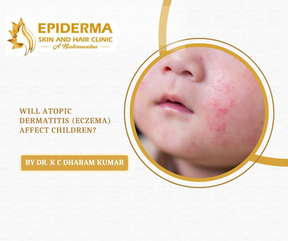 Skin Specialist in Jayanagar | Dr. KC Dharam Kumar