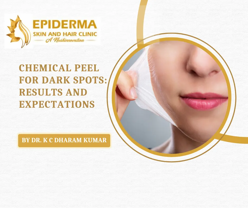 Treatment for Chemical Peels in Jayanagar