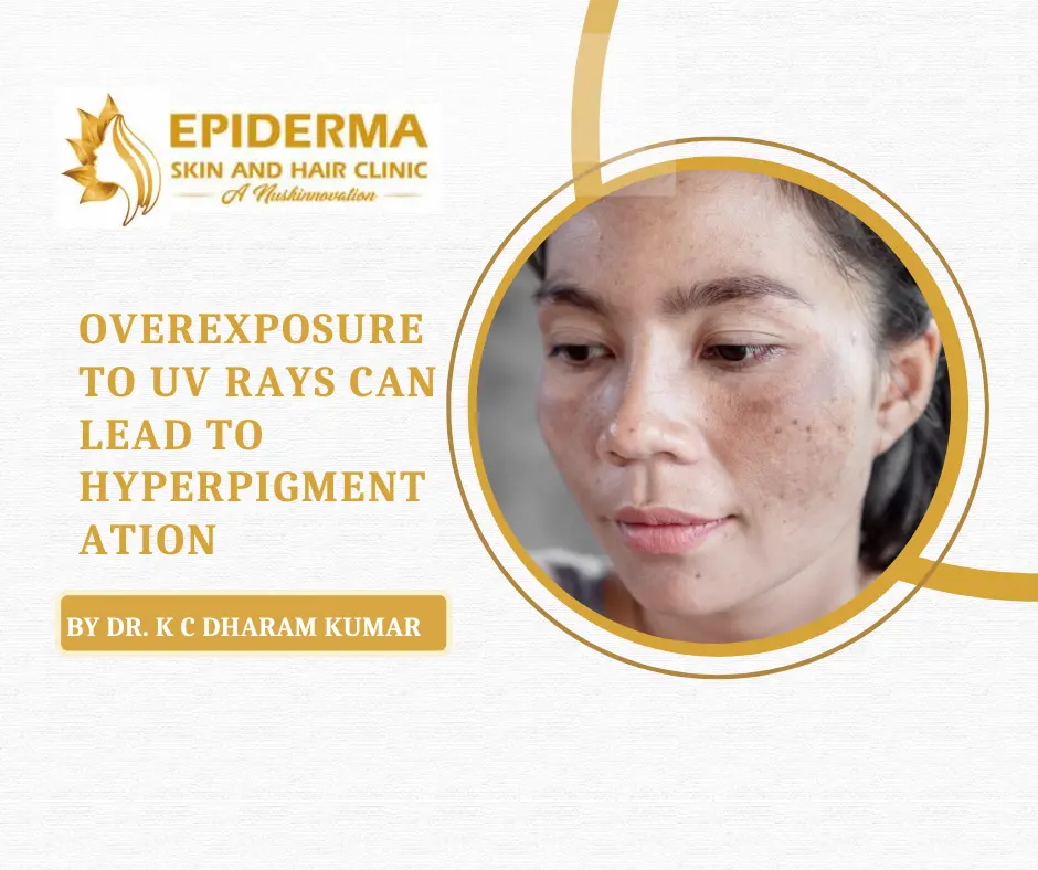 Hyperpigmentation Treatment in Bangalore